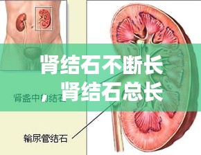 肾结石不断长，肾结石总长是怎么回事 